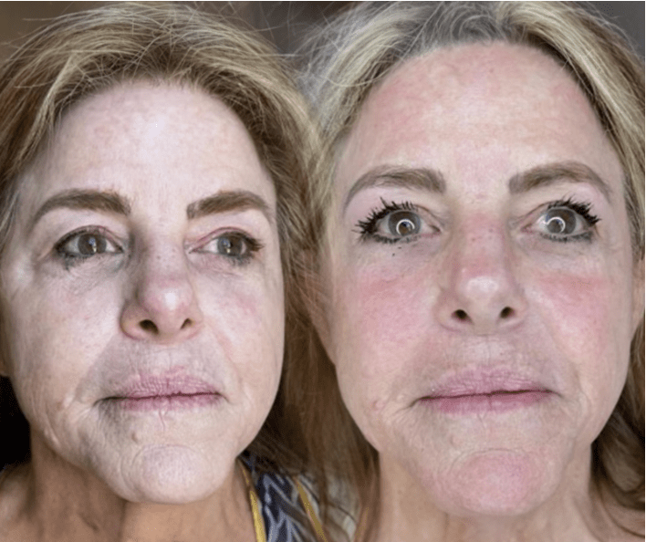 Skin Tightening