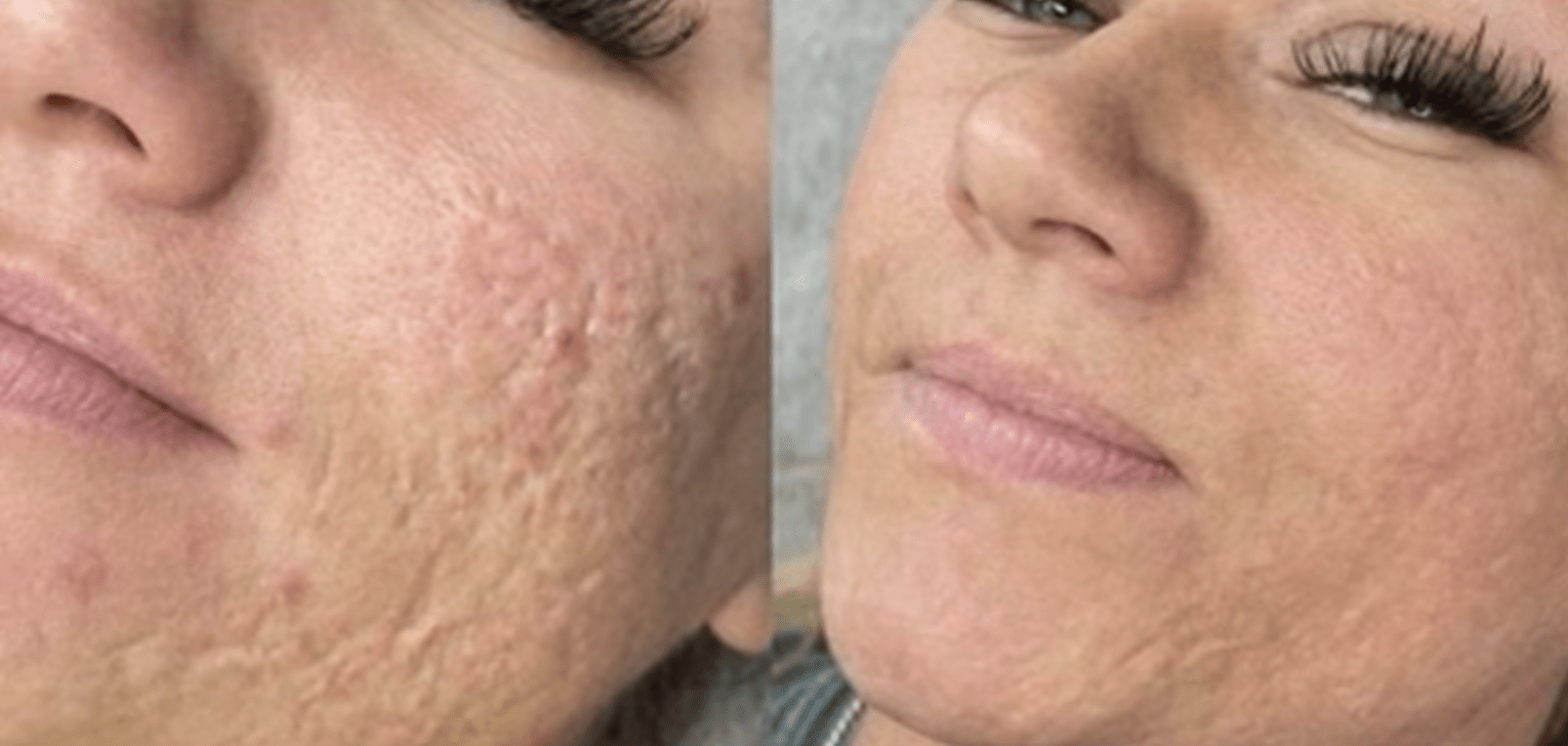 Skin Tightening